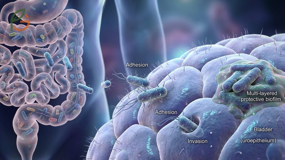How E. coli causes UTI via type 1 pili attachment during the first 24-48 hours of bacterial entry.
